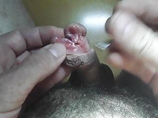 Cutting increased by subincision